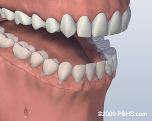 Denture Attached Henderson, TX