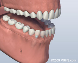 Denture Attached Henderson, TX 75654